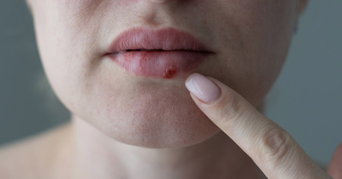 Pritelivir: la pastilla que rompió 30 años de estancamiento contra el herpes resistente