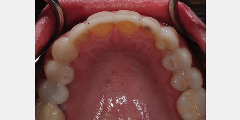 Carillas dentales: las señales de una filtración que pueden empeorar el diente